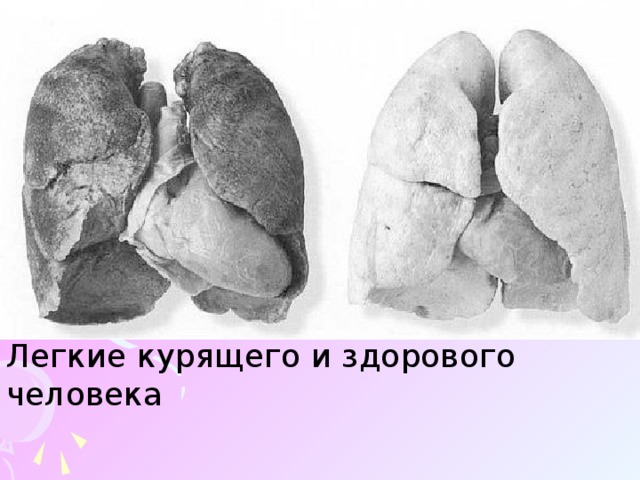 Как выглядит легкие после сигарет