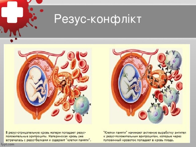 Резус-конфлікт