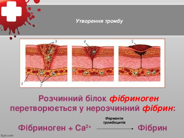 Утворення тромбу  Розчинний білок фібриноген  перетворюється у нерозчинний фібрин :  Фібриноген + Са 2+ Фібрин Ферменти тромбоцитів