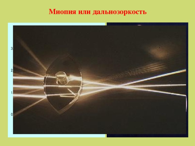 Миопия или дальнозоркость 