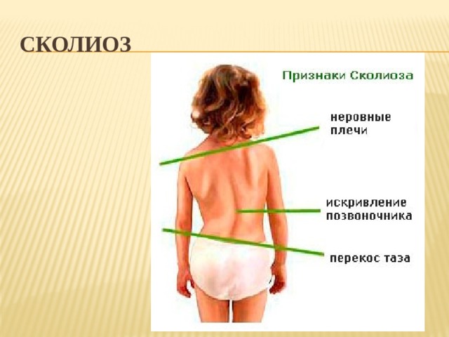 Сколиоз 