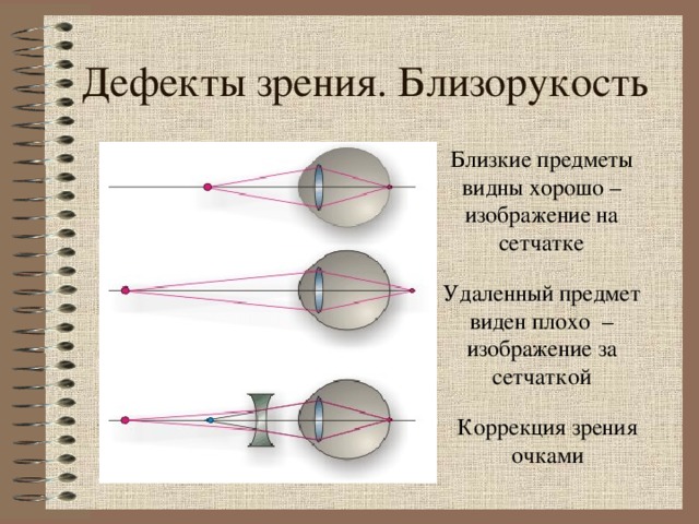 Дефекты зрения. Близорукость Близкие предметы видны хорошо – изображение на сетчатке Удаленный предмет виден плохо – изображение за сетчаткой Рисунок с сайта http : //www. Fizika.ru Коррекция зрения очками  