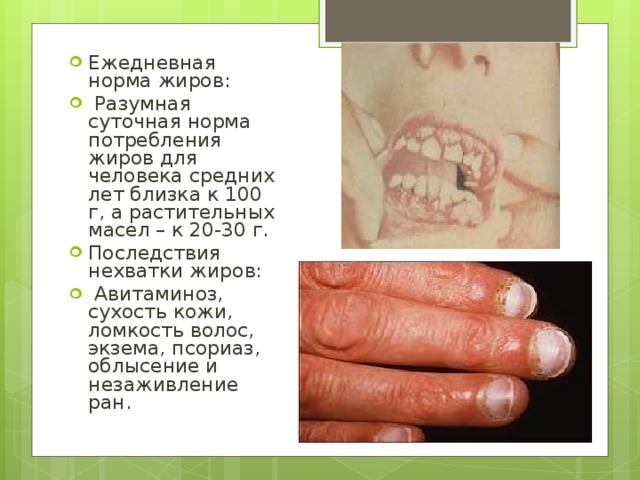 Ежедневная норма жиров:  Разумная суточная норма потребления жиров для человека средних лет близка к 100 г, а растительных масел – к 20-30 г. Последствия нехватки жиров:  Авитаминоз, сухость кожи, ломкость волос, экзема, псориаз, облысение и незаживление ран. 