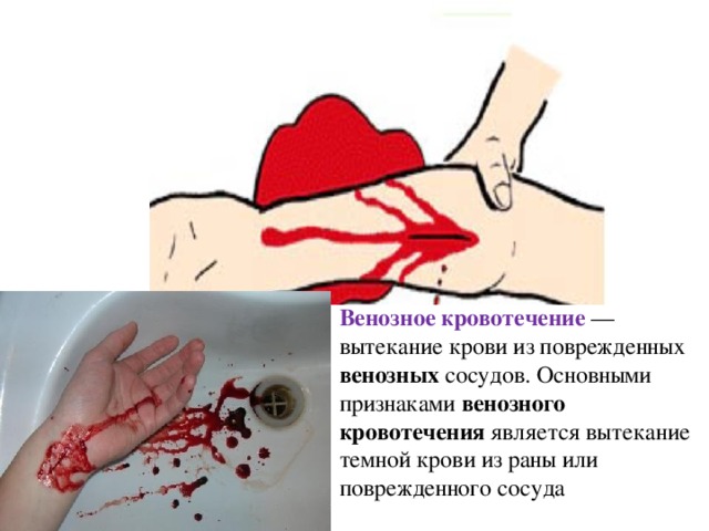 Венозное кровотечение  —вытекание крови из поврежденных венозных  сосудов. Основными признаками  венозного кровотечения  является вытекание темной крови из раны или поврежденного сосуда 