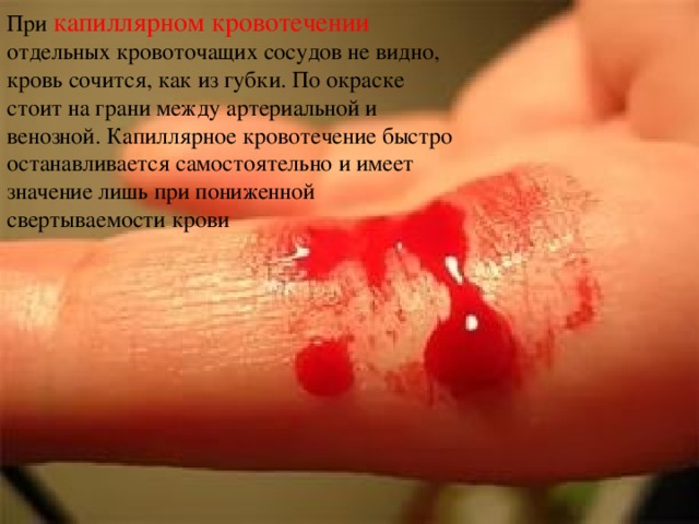 При капиллярном кровотечении отдельных кровоточащих сосудов не видно, кровь сочится, как из губки. По окраске стоит на грани между артериальной и венозной. Капиллярное кровотечение быстро останавливается самостоятельно и имеет значение лишь при пониженной свертываемости крови 