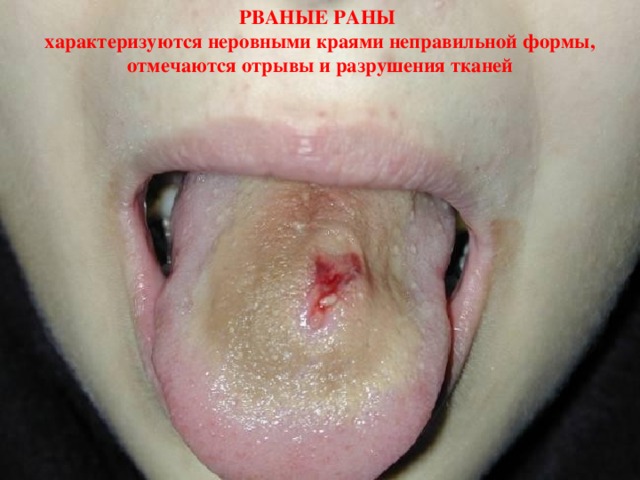 РВАНЫЕ РАНЫ  характеризуются неровными краями неправильной формы, отмечаются отрывы и разрушения тканей 