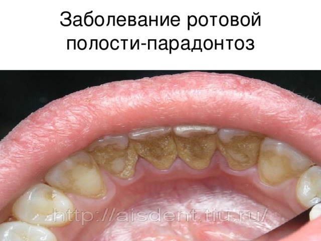 Заболевание ротовой полости-парадонтоз 