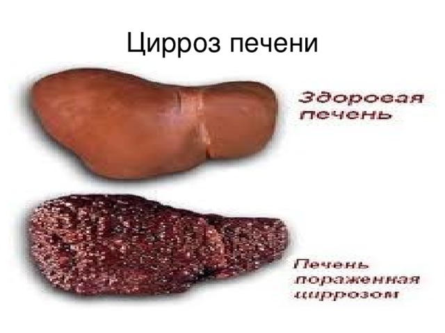Цирроз печени 