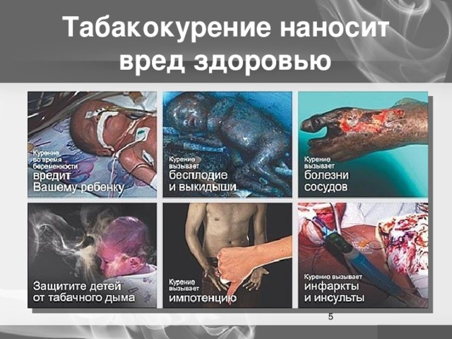 Табакокурение наносит вред здоровью  