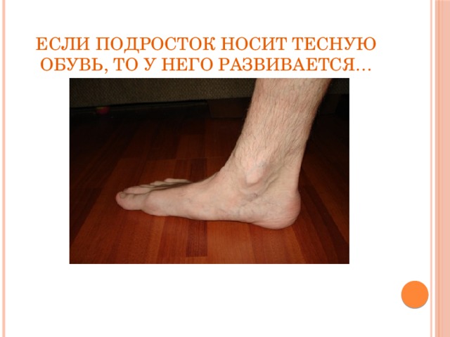 Если подросток носит тесную обувь, то у него развивается…