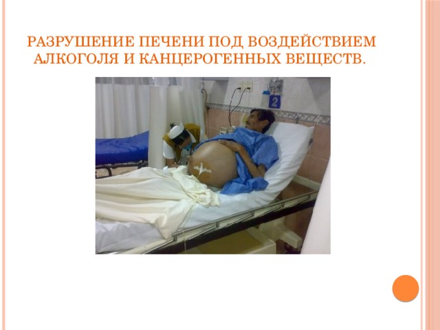 Разрушение печени под воздействием алкоголя и канцерогенных веществ.