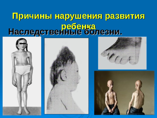 Причины нарушения развития ребенка   Наследственные болезни.   1 синдром морфана 2 клайфельтерра  