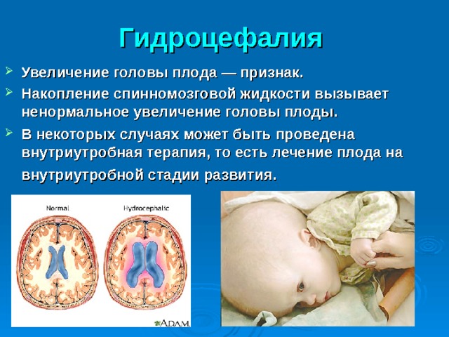 Гидроцефалия  Увеличение головы плода — признак. Накопление спинномозговой жидкости вызывает ненормальное увеличение головы плоды. В некоторых случаях может быть проведена внутриутробная терапия, то есть лечение плода на внутриутробной стадии развития.  Гидроцефалия — это только симптом, который может быть следствием нескольких причин, в число которых могут входить spina bifida, менингит и омфалит.  