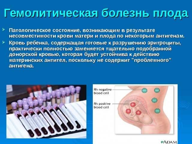 Гемолитическая болезнь плода Патологическое состояние, возникающим в результате несовместимости крови матери и плода по некоторым антигенам. Кровь ребенка, содержащая готовые к разрушению эритроциты, практически полностью заменяется тщательно подобранной донорской кровью, которая будет устойчива к действию материнских антител, поскольку не содержит 