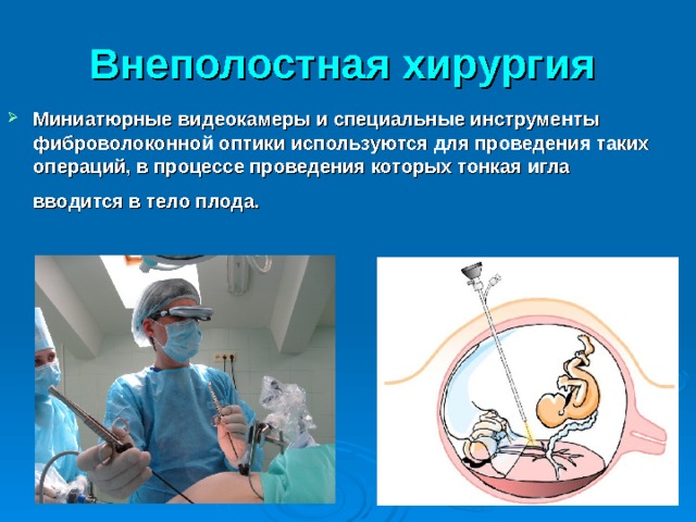 Внеполостная хирургия  Миниатюрные видеокамеры и специальные инструменты фиброволоконной оптики используются для проведения таких операций, в процессе проведения которых тонкая игла вводится в тело плода.  