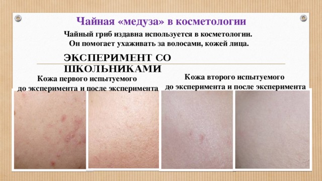 Чайная «медуза» в косметологии Чайный гриб издавна используется в косметологии. Он помогает ухаживать за волосами, кожей лица. ЭКСПЕРИМЕНТ СО ШКОЛЬНИКАМИ  Кожа второго испытуемого до эксперимента и после эксперимента  Кожа первого испытуемого до эксперимента и после эксперимента 