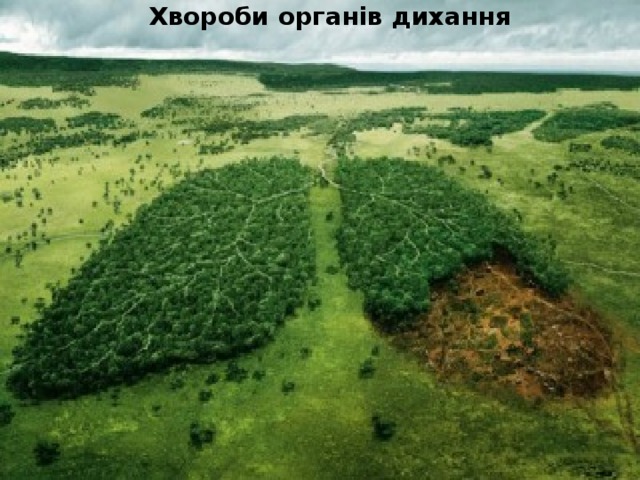  Хвороби органiв дихання 