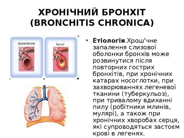 ХРОНІЧНИЙ БРОНХІТ (BRONCHITIS CHRONICA) Етіологія .Хрош'чне запалення слизової оболонки бронхів може розвинутися після повторних гострих бронхітів, при хронічних катарах носоглотки, при захворюваннях легеневої тканини (туберкульоз), при тривалому вдиханні пилу (робітники млинів, мулярі), а також при хронічних хворобах серця, які супроводяться застоєм крові в легенях. 