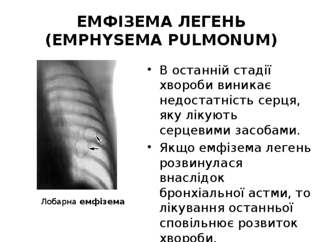 ЕМФІЗЕМА ЛЕГЕНЬ (EMPHYSEMA PULMONUM) В останній стадії хвороби виникає недостатність серця, яку лікують серцевими засобами. Якщо емфізема легень розвинулася внаслідок бронхіальної астми, то лікування останньої сповільнює розвиток хвороби. Лобарна емфізема  