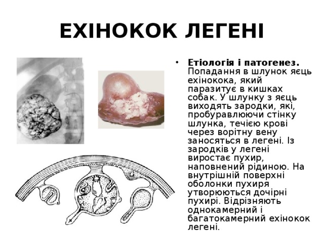 ЕХІНОКОК ЛЕГЕНІ Етіологія і патогенез. Попадання в шлунок яєць ехінокока, який паразитує в кишках собак. У шлунку з яєць виходять зародки, які, пробуравлюючи стінку шлунка, течією крові через ворітну вену заносяться в легенi. Із зародків у легенi виростає пухир, наповнений рідиною. На внутрішній поверхні оболонки пухиря утворюються дочірні пухирі. Відрізняють однокамерний і багатокамерний ехінокок легенi. 