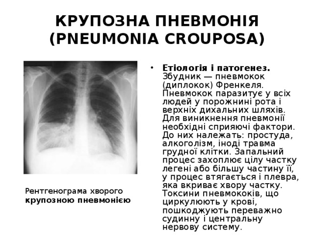 КРУПОЗНА ПНЕВМОНІЯ (PNEUMONIA CROUPOSA) Етіологія і патогенез. Збудник — пневмокок (диплокок) Френкеля. Пневмокок паразитує у всіх людей у порожнині рота і верхніх дихальних шляхів. Для виникнення пневмонії необхідні сприяючі фактори. До них належать: простуда, алкоголізм, іноді травма грудної клітки. Запальний процес захоплює цілу частку легені або більшу частину її, у процес втягається і плевра, яка вкриває хвору частку. Токсини пневмококів, що циркулюють у крові, пошкоджують переважно судинну і центральну нервову систему. Рентгенограма хворого крупозною пневмонією  