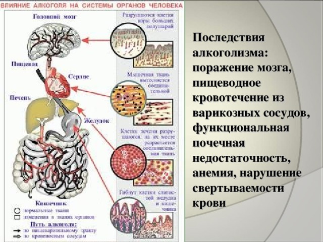 Последствия алкоголизма:  поражение мозга, пищеводное кровотечение из варикозных сосудов, функциональная почечная недостаточность, анемия, нарушение свертываемости крови 