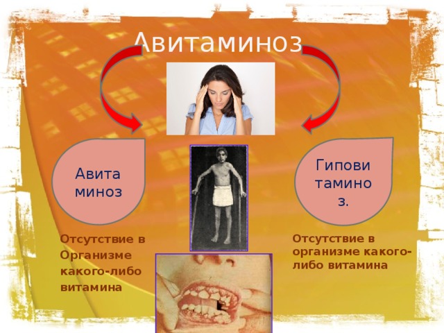 Авитаминоз. Авитаминоз Гиповитаминоз. Отсутствие в организме какого-либо витамина Отсутствие в Организме какого-либо витамина 