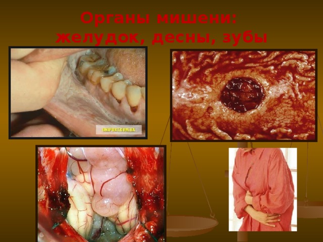 Органы мишени: желудок, десны, зубы 