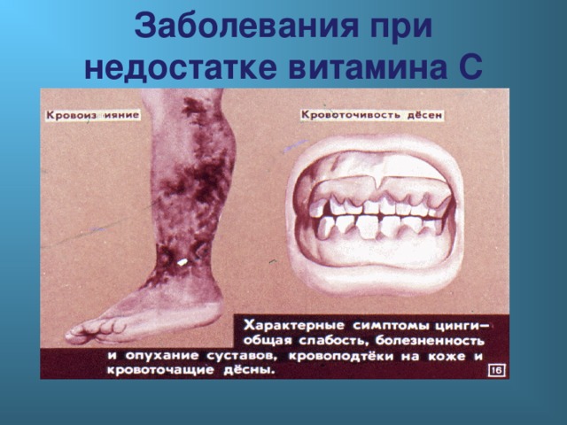 Заболевания при недостатке витамина С 