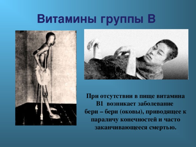 Витамины группы В При отсутствии в пище витамина В1 возникает заболевание бери – бери (оковы), приводящее к параличу конечностей и часто заканчивающееся смертью. 