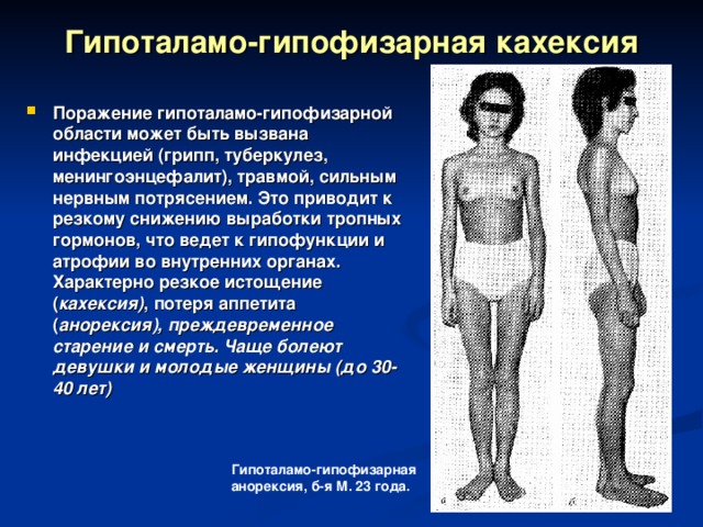 Гипоталамо-гипофизарная кахексия Поражение гипоталамо-гипофизарной области может быть вызвана инфекцией (грипп, туберкулез, менингоэнцефалит), травмой, сильным нервным потрясением. Это приводит к резкому снижению выработки тропных гормонов, что ведет к гипофункции и атрофии во внутренних органах. Характерно резкое истощение ( кахексия) , потеря аппетита ( анорексия), преждевременное старение и смерть. Чаще болеют девушки и молодые женщины (до 30-40 лет) Гипоталамо-гипофизарная анорексия, б-я М. 23 года. 