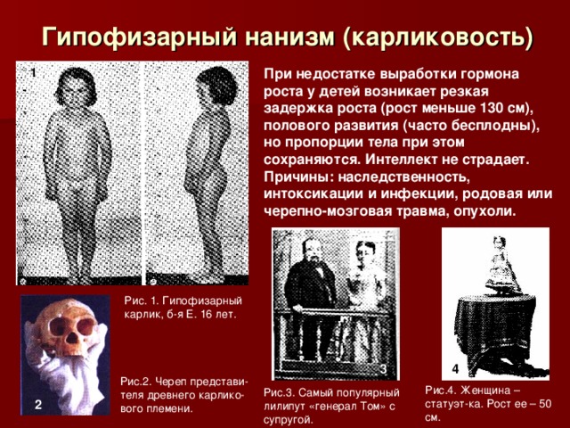 Гипофизарный нанизм (карликовость) При недостатке выработки гормона роста у детей возникает резкая задержка роста (рост меньше 130 см), полового развития (часто бесплодны), но пропорции тела при этом сохраняются. Интеллект не страдает. Причины: наследственность, интоксикации и инфекции, родовая или черепно-мозговая травма, опухоли. 1 Рис. 1. Гипофизарный карлик, б-я Е. 16 лет. 3 4 Рис.2. Череп представи-теля древнего карлико-вого племени. Рис.4. Женщина – статуэт-ка. Рост ее – 50 см. Рис.3. Самый популярный лилипут «генерал Том» с супругой. 2 