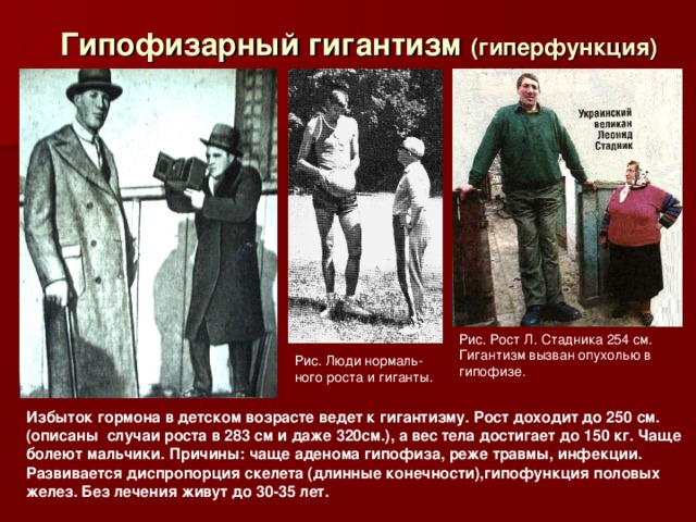 Гипофизарный гигантизм (гиперфункция) Рис. Рост Л. Стадника 254 см. Гигантизм вызван опухолью в гипофизе. Рис. Люди нормаль-ного роста и гиганты. Избыток гормона в детском возрасте ведет к гигантизму. Рост доходит до 250 см. (описаны случаи роста в 283 см и даже 320см.), а вес тела достигает до 150 кг. Чаще болеют мальчики. Причины: чаще аденома гипофиза, реже травмы, инфекции. Развивается диспропорция скелета (длинные конечности),гипофункция половых желез. Без лечения живут до 30-35 лет. 
