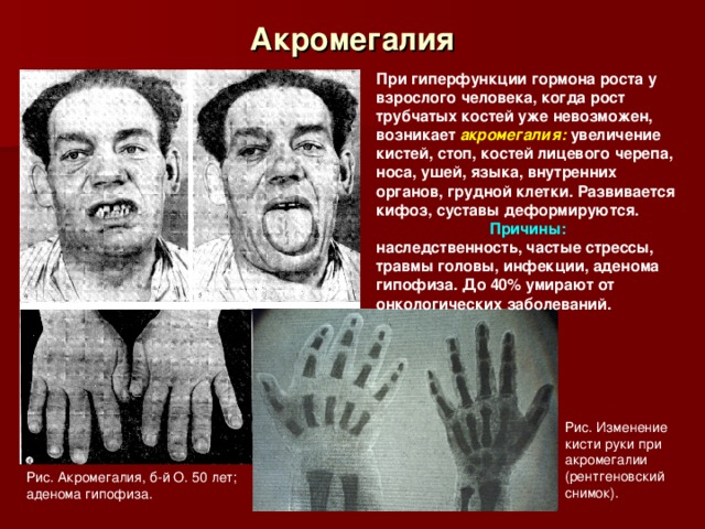 Акромегалия При гиперфункции гормона роста у взрослого человека, когда рост трубчатых костей уже невозможен, возникает акромегалия: увеличение кистей, стоп, костей лицевого черепа, носа, ушей, языка, внутренних органов, грудной клетки. Развивается кифоз, суставы деформируются. Причины: наследственность, частые стрессы, травмы головы, инфекции, аденома гипофиза. До 40% умирают от онкологических заболеваний. Рис. Изменение кисти руки при акромегалии (рентгеновский снимок). Рис. Акромегалия, б-й О. 50 лет; аденома гипофиза. 