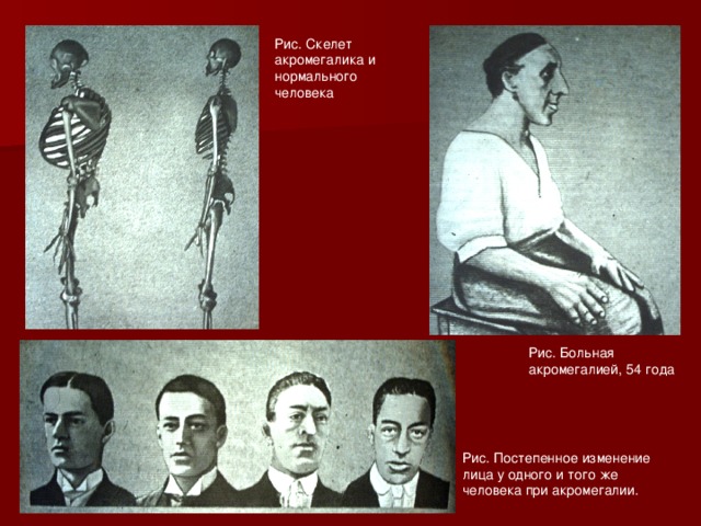Рис. Скелет акромегалика и нормального человека Рис. Больная акромегалией, 54 года Рис. Постепенное изменение лица у одного и того же человека при акромегалии. 