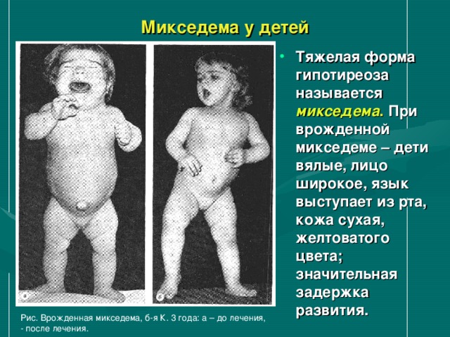 Микседема у детей Тяжелая форма гипотиреоза называется микседема . При врожденной микседеме – дети вялые, лицо широкое, язык выступает из рта, кожа сухая, желтоватого цвета; значительная задержка развития. Рис. Врожденная микседема, б-я К. 3 года: а – до лечения, - после лечения. 