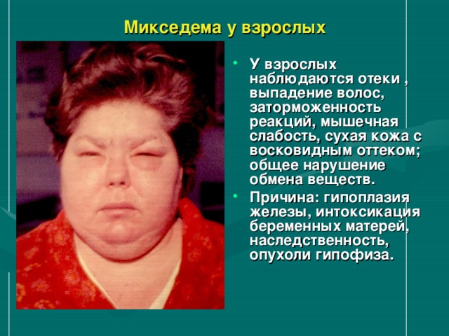 Микседема у взрослых У взрослых наблюдаются отеки , выпадение волос, заторможенность реакций, мышечная слабость, сухая кожа с восковидным оттеком; общее нарушение обмена веществ. Причина: гипоплазия железы, интоксикация беременных матерей, наследственность, опухоли гипофиза.  