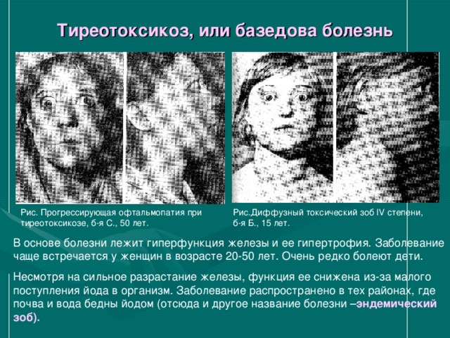 Тиреотоксикоз, или базедова болезнь Рис. Прогрессирующая офтальмопатия при тиреотоксикозе, б-я С., 50 лет. Рис.Диффузный токсический зоб IV степени, б-я Б., 15 лет. эндемический зоб). 