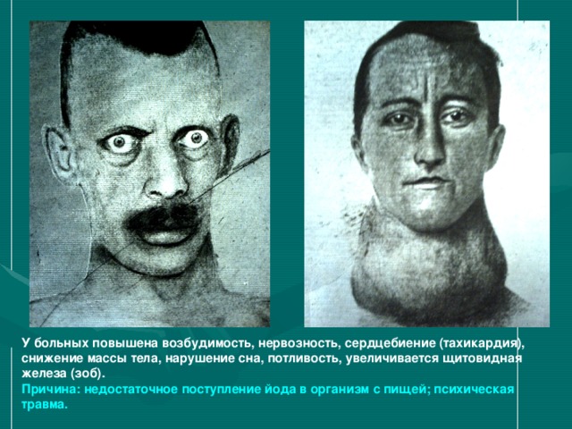 У больных повышена возбудимость, нервозность, сердцебиение (тахикардия), снижение массы тела, нарушение сна, потливость, увеличивается щитовидная железа (зоб). Причина: недостаточное поступление йода в организм с пищей; психическая травма.  