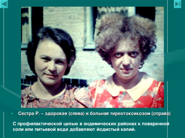 Сестра Р. – здоровая (слева) и больная тиреотоксикозом (справа) С профилактической целью в эндемических районах к поваренной соли или питьевой воде добавляют йодистый калий.  