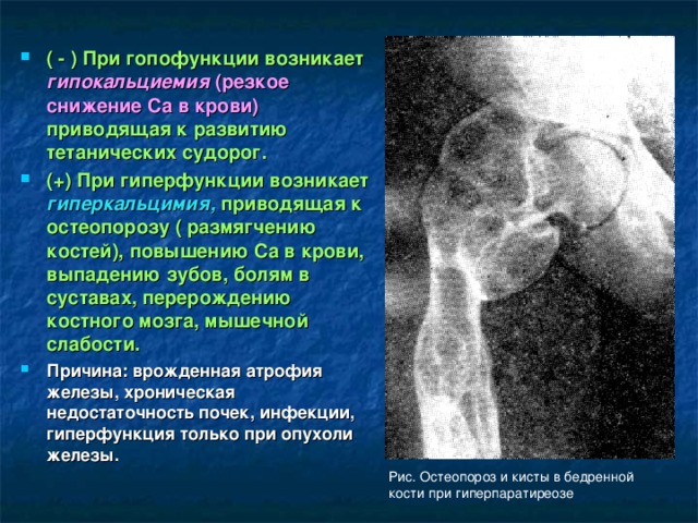 ( - ) При гопофункции возникает гипокальциемия (резкое снижение Са в крови) приводящая к развитию тетанических судорог. (+) При гиперфункции возникает гиперкальцимия, приводящая к остеопорозу ( размягчению костей), повышению Са в крови, выпадению зубов, болям в суставах, перерождению костного мозга, мышечной слабости. Причина: врожденная атрофия железы, хроническая недостаточность почек, инфекции, гиперфункция только при опухоли железы.  Рис. Остеопороз и кисты в бедренной кости при гиперпаратиреозе 