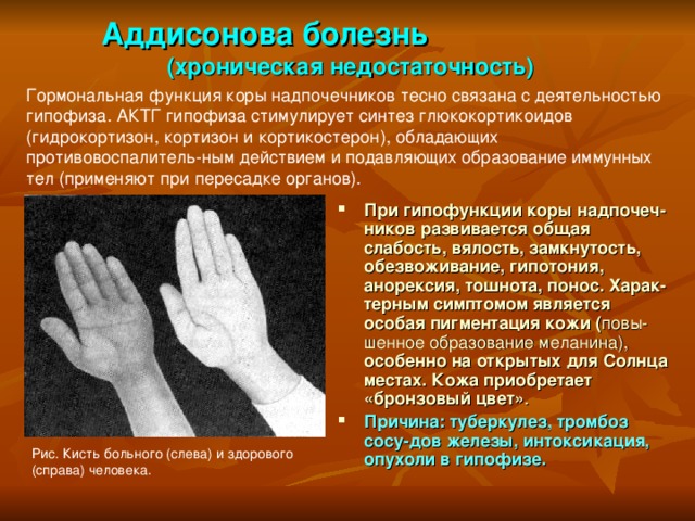  Аддисонова болезнь  (хроническая недостаточность)  Гормональная функция коры надпочечников тесно связана с деятельностью гипофиза. АКТГ гипофиза стимулирует синтез глюкокортикоидов (гидрокортизон, кортизон и кортикостерон), обладающих противовоспалитель-ным действием и подавляющих образование иммунных тел (применяют при пересадке органов). При гипофункции коры надпочеч-ников развивается общая слабость, вялость, замкнутость, обезвоживание, гипотония, анорексия, тошнота, понос. Харак-терным симптомом является особая пигментация кожи ( повы-шенное образование меланина), особенно  на открытых для Солнца местах. Кожа приобретает «бронзовый цвет» . Причина: туберкулез, тромбоз сосу-дов железы, интоксикация, опухоли в гипофизе. Рис. Кисть больного (слева) и здорового (справа) человека. 