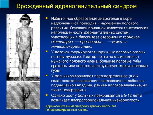 Врожденный адреногенитальный синдром Избыточное образование андрогенов в коре надпочечников приводит к нарушению полового развития. Основной причиной является генетическая неполноценность ферментативных систем, участвующих в биосинтезе стероидных гормонов ( холестерин прогестерон глико- и минералокортикоиды). У девочек формируются наружные  половые органы по типу мужских. Клитор почти не отличается от мужского полового члена; большие половые губы сражены или полностью отсутствуют малые половые губы. У мальчиков возникает преждевременное (в 2-4 года) половое созревание: оволосение на лобке и в подмышечной впадине, раннее половое влечение, но яички недоразвиты Однако рост у больных прекращается в 9-12 лет и возникает диспропорциональная низкорослость. Адреногенитальный синдром у девочки шести лет. Гипертрофированный клитор. 