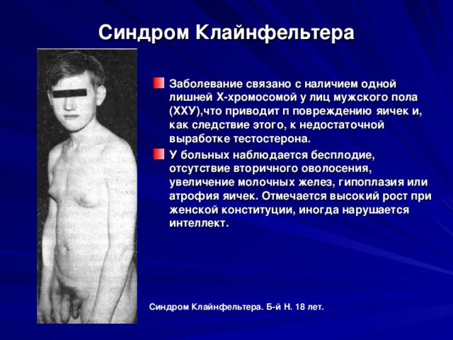 Синдром Клайнфельтера Заболевание связано с наличием одной лишней Х-хромосомой у лиц мужского пола (ХХУ),что приводит п повреждению яичек и, как следствие этого, к недостаточной выработке тестостерона. У больных наблюдается бесплодие, отсутствие вторичного оволосения, увеличение молочных желез, гипоплазия или атрофия яичек. Отмечается высокий рост при женской конституции, иногда нарушается интеллект. Синдром Клайнфельтера. Б-й Н. 18 лет. 