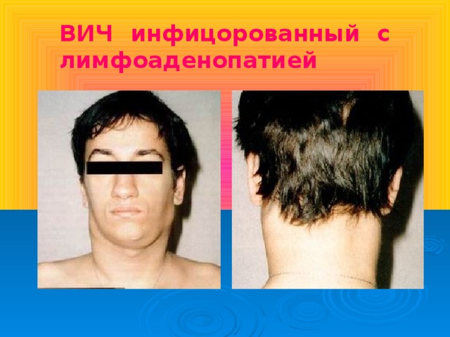 ВИЧ инфицорованный с лимфоаденопатией