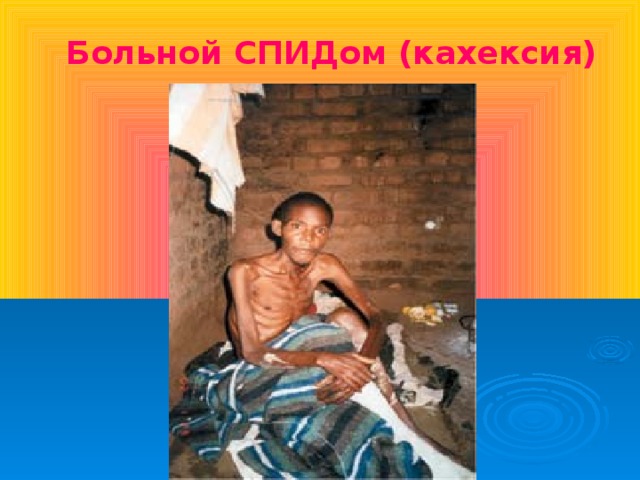 Больной СПИДом (кахексия)