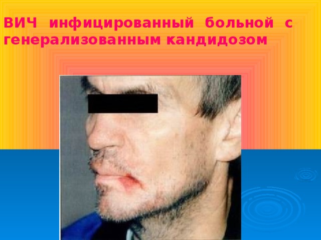 ВИЧ инфицированный больной с генерализованным кандидозом