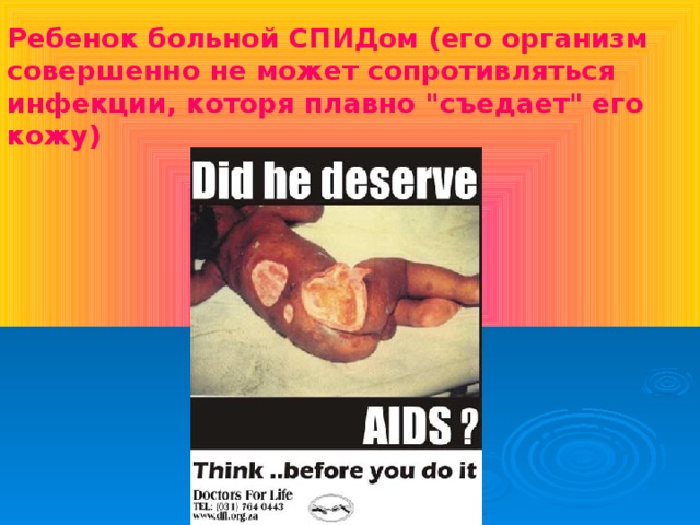 Ребенок больной СПИДом (его организм совершенно не может сопротивляться инфекции, которя плавно 