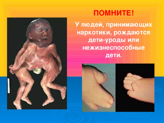 ПОМНИТЕ! У людей, принимающих наркотики, рождаются дети-уроды или нежизнеспособные дети .