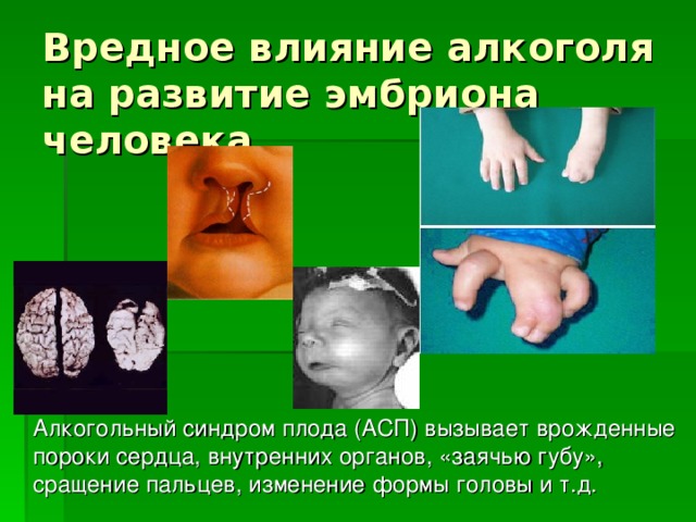 Вредное влияние алкоголя на развитие эмбриона человека  Алкогольный синдром плода (АСП) вызывает врожденные пороки сердца, внутренних органов, «заячью губу», сращение пальцев, изменение формы головы и т.д. 